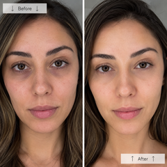 Risultato Kit Benessere — before after occhiaie