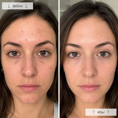 Risultato fototerapia LED viso — before after imperfezioni